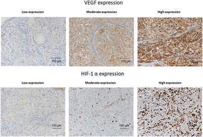 Intermittent Hypoxia Is Associated With High Hypoxia Inducible Factor-1α but Not High Vascular Endothelial Growth Factor Cell Expression in Tumors of Cutaneous Melanoma Patients